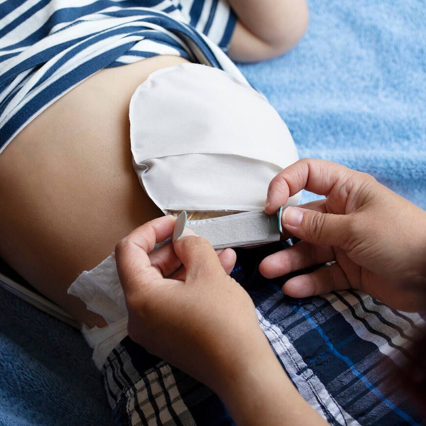 Thème 4 | Le soin des stomies pédiatriques