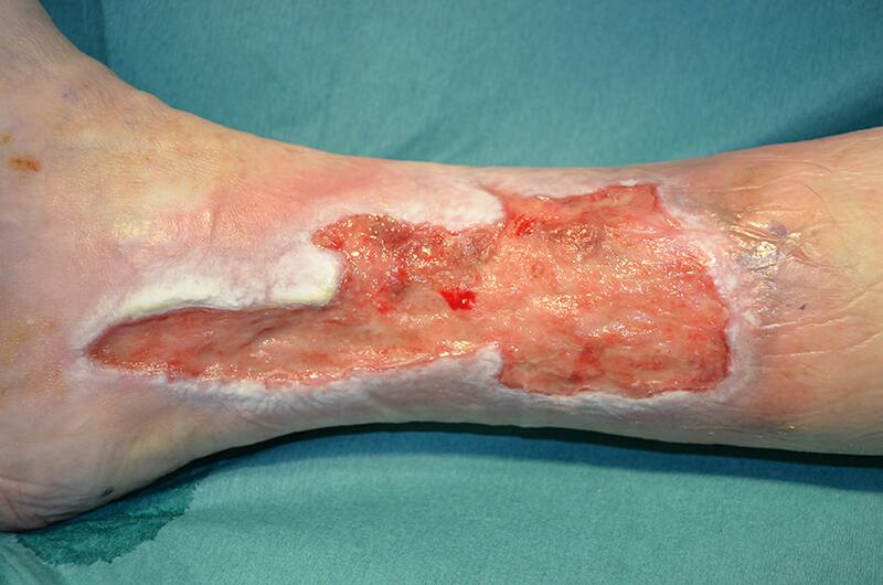 Ulcère des membres inférieurs