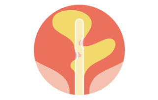 Learn more urethral and bladder microtrauma