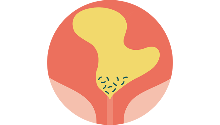 What is the link between residual urine and UTIs?